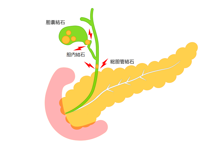 胆石・胆石症とは？