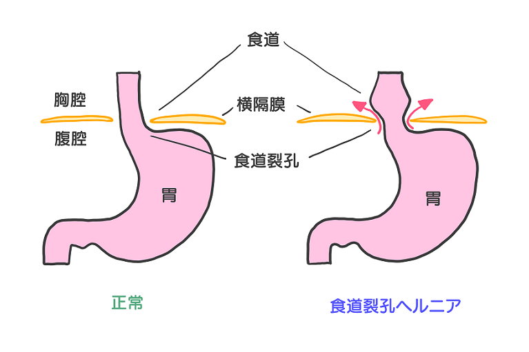 食道裂孔ヘルニアとは？