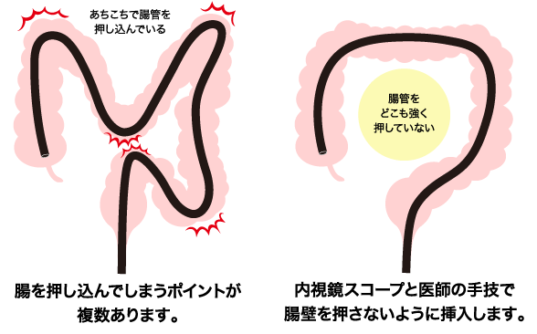 苦痛を限りなく抑えた挿入法｢軸保持短縮法｣を実施