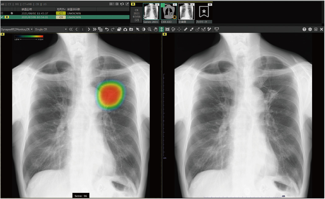 人工知能で胸部X線の見落とし防止を支援